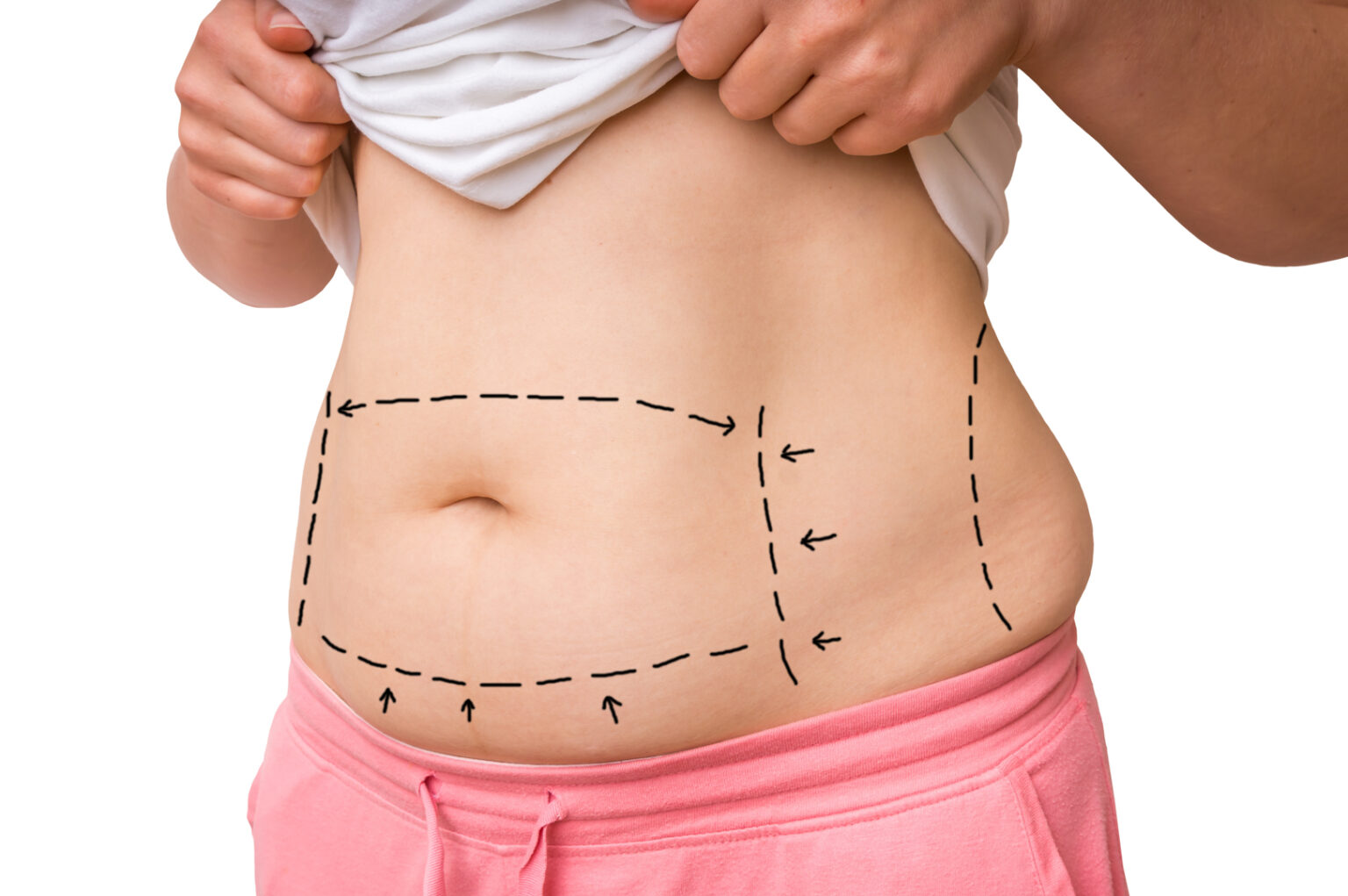 Abdominal Etching In Turkey Price Dr Ali Mezde I