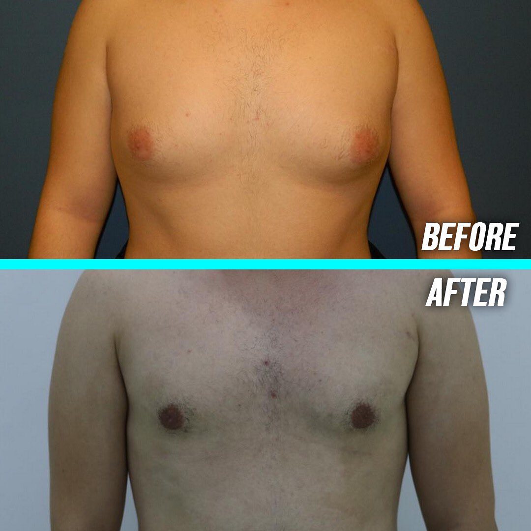 1 week after gynecomastia surgery