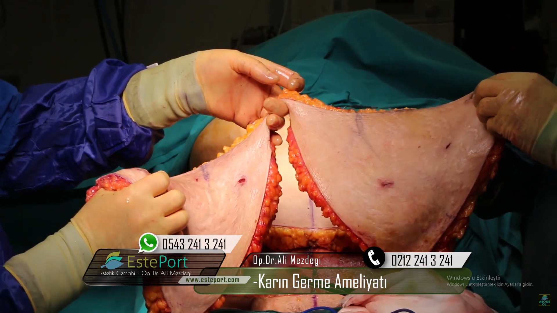 Abdominoplasty Surgery Turkey