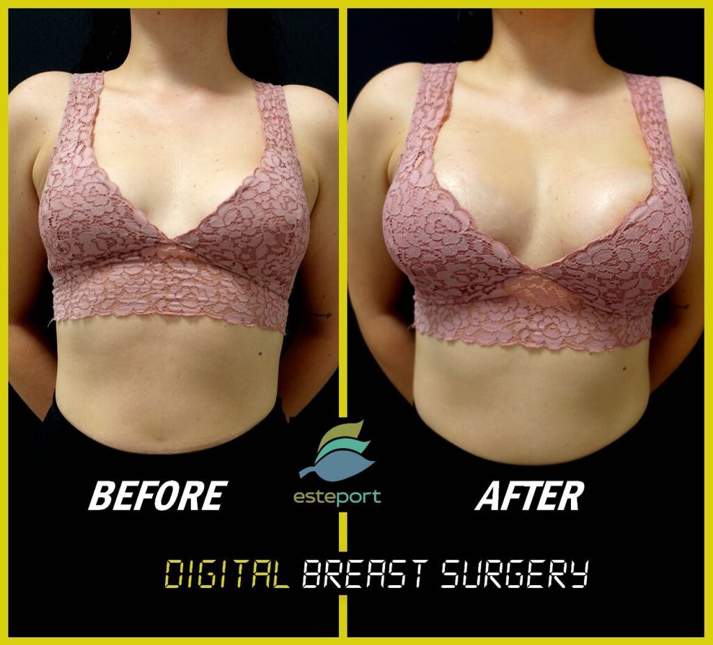 Improve Breast Asymmetry Through Augmentation - Ohio Plastic