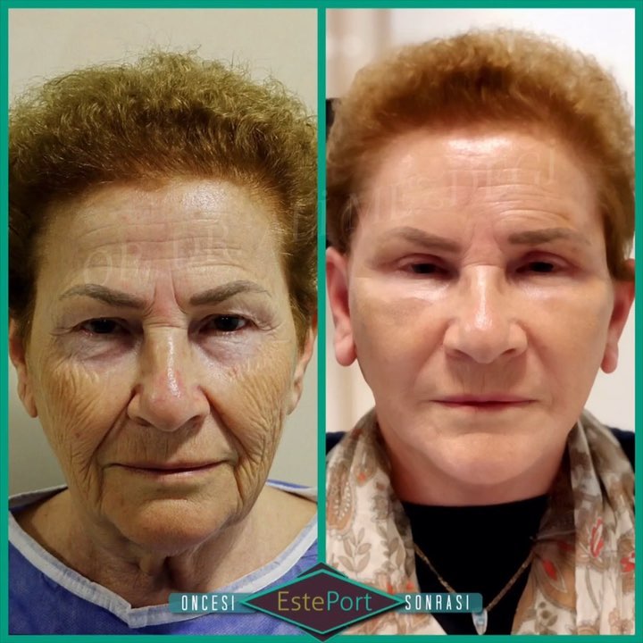 Deep plane facelift before and after in Turkey