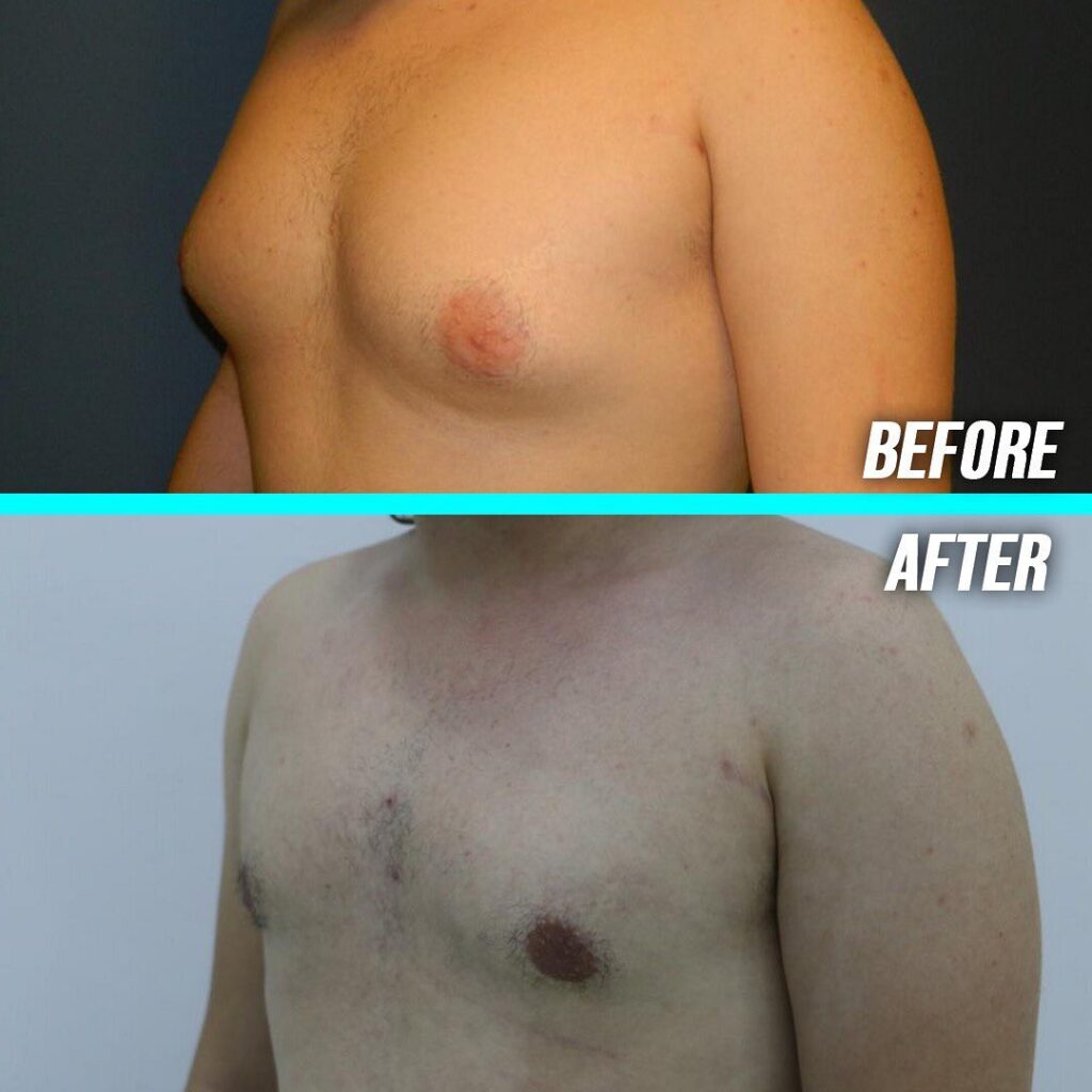 Gynecomastia Degrees