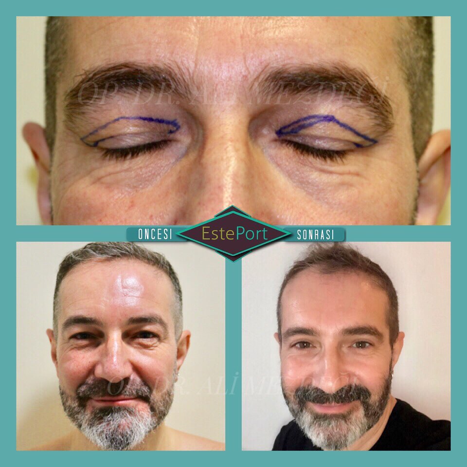 Lower Blepharoplasty Men