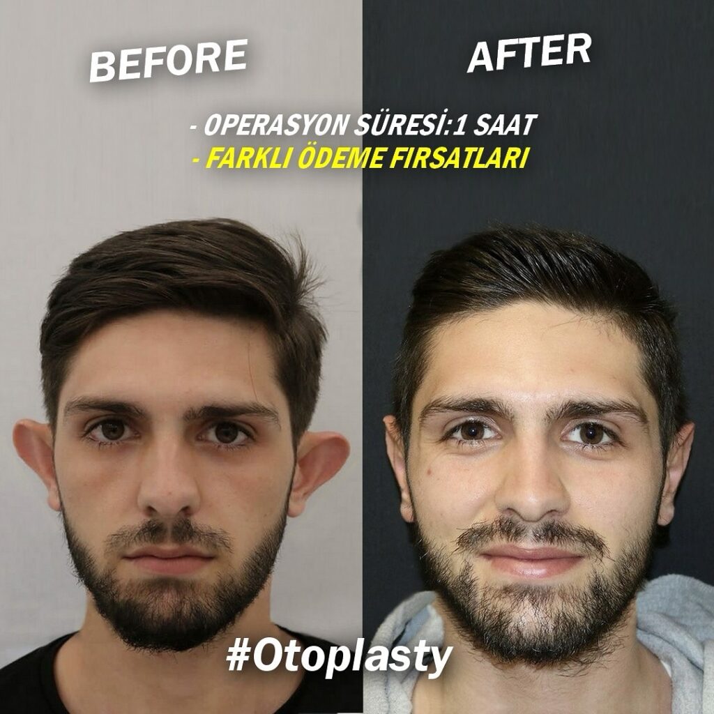 Otoplasty Revision Turkey