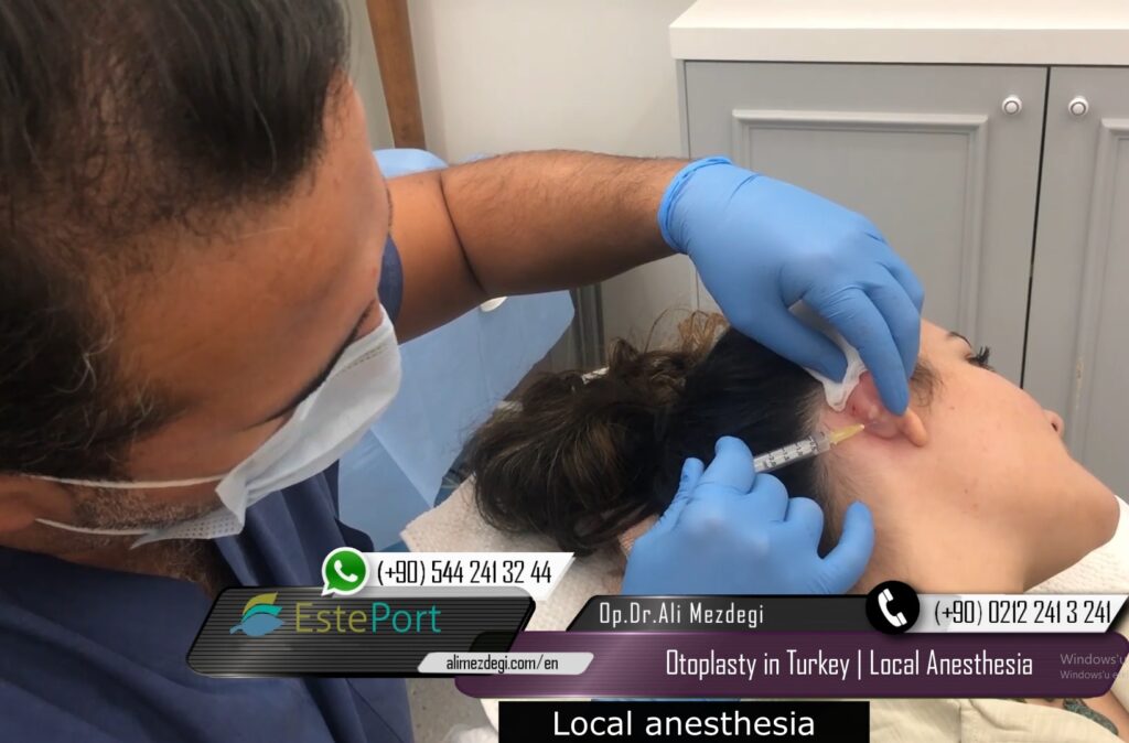 Otoplasty Under Local Anesthesia