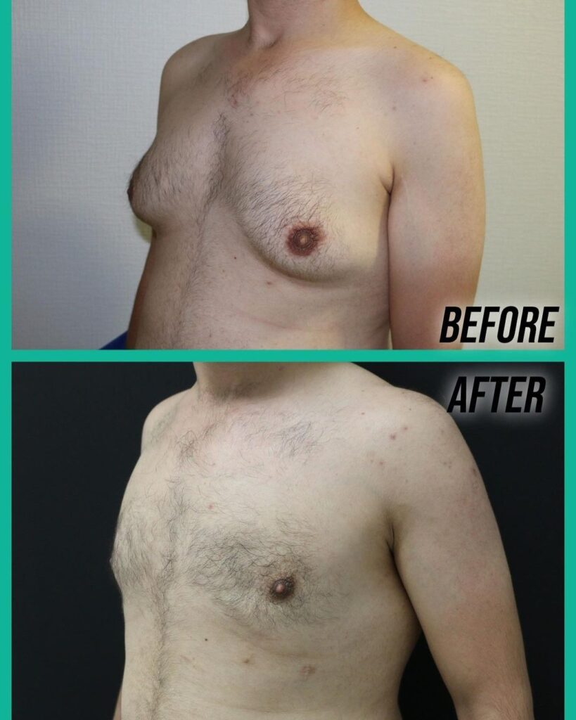 Pseudogynecomastia in Turkey