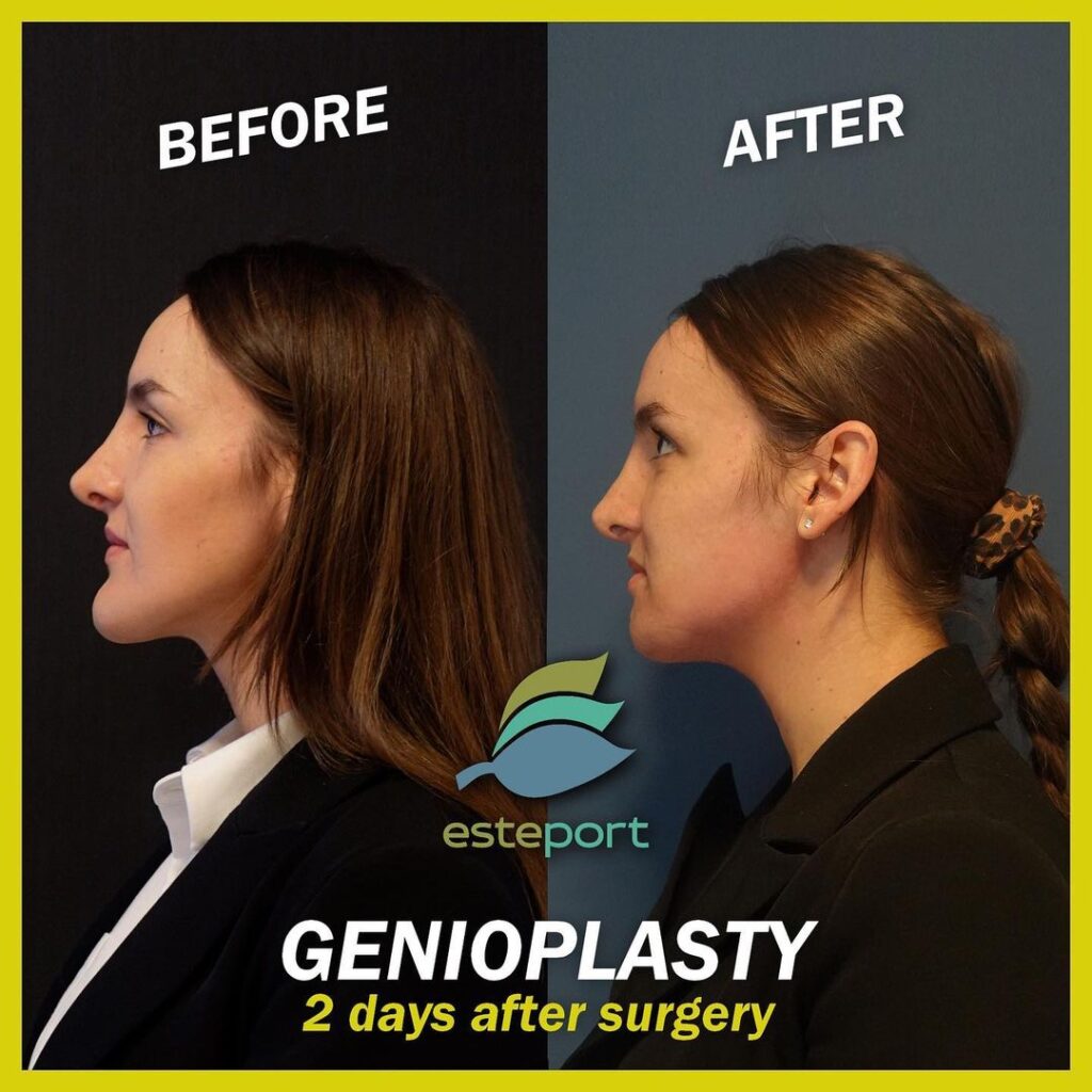 genioplasty turkey