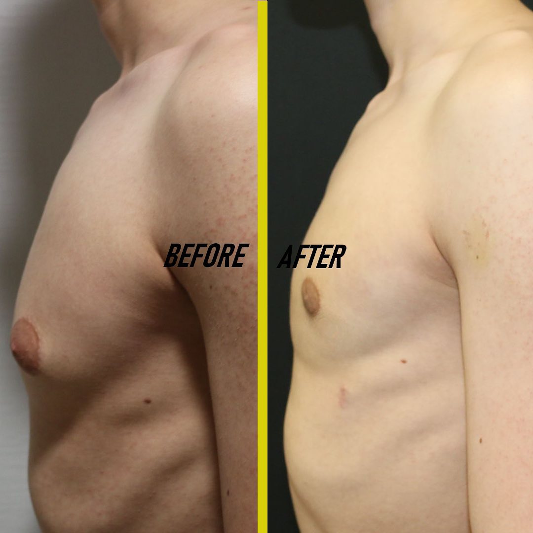 gynecomastia recovery day by day