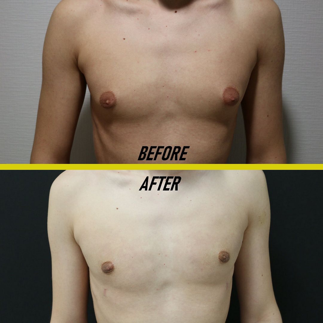 gynecomastia surgery before and after