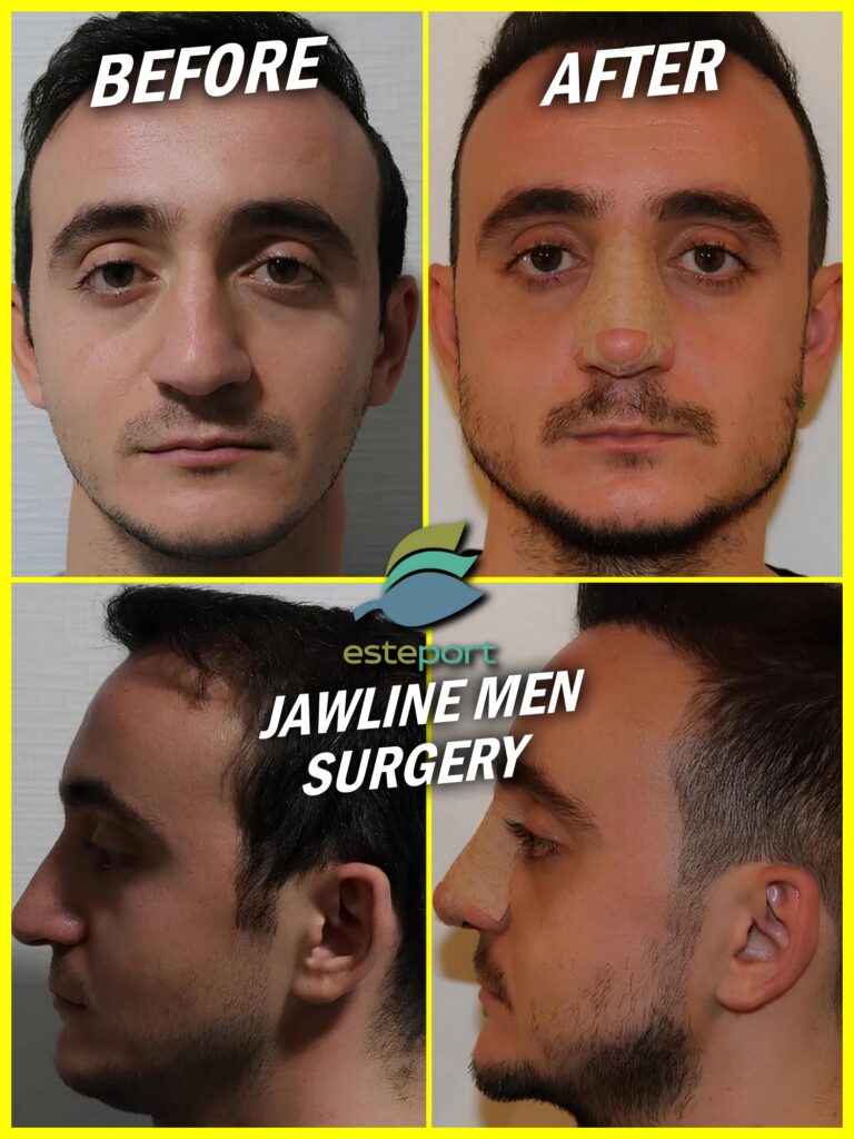 jawline men surgery